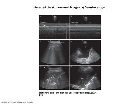 Selected chest ultrasound images. a) Sea-shore sign.