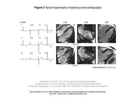 Figure 2 Apical hypertrophy missed by echocardiography