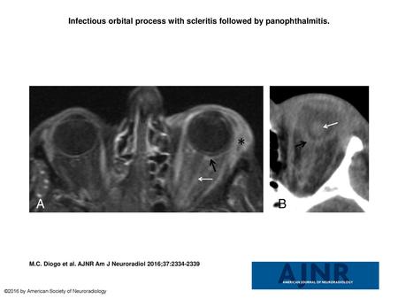 Infectious orbital process with scleritis followed by panophthalmitis.