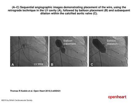 (A–C) Sequential angiographic images demonstrating placement of the wire, using the retrograde technique in the LV cavity (A), followed by balloon placement.