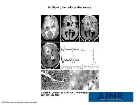 Multiple tuberculous abscesses.