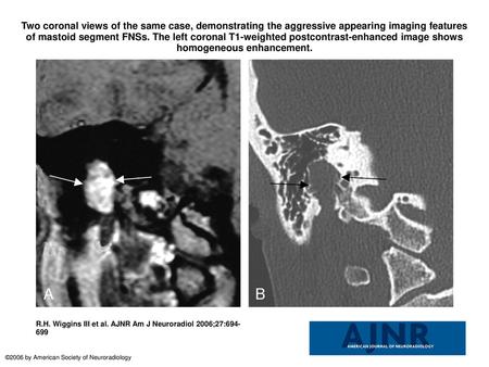 Two coronal views of the same case, demonstrating the aggressive appearing imaging features of mastoid segment FNSs. The left coronal T1-weighted postcontrast-enhanced.