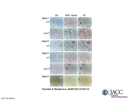 Tarvinder S. Dhanjal et al. JACEP 2017;3: