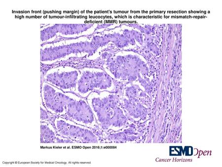 Invasion front (pushing margin) of the patient's tumour from the primary resection showing a high number of tumour-infiltrating leucocytes, which is characteristic.