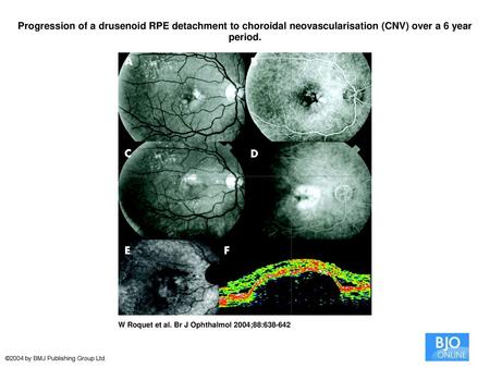 Progression of a drusenoid RPE detachment to choroidal neovascularisation (CNV) over a 6 year period. Progression of a drusenoid RPE detachment to choroidal.