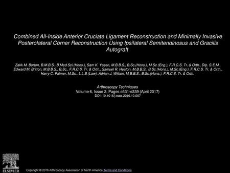 Combined All-Inside Anterior Cruciate Ligament Reconstruction and Minimally Invasive Posterolateral Corner Reconstruction Using Ipsilateral Semitendinosus.