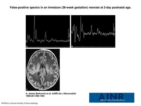 False-positive spectra in an immature (36-week gestation) neonate at 2-day postnatal age. False-positive spectra in an immature (36-week gestation) neonate.