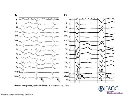 Mark E. Josephson, and Elad Anter JACEP 2015;1: