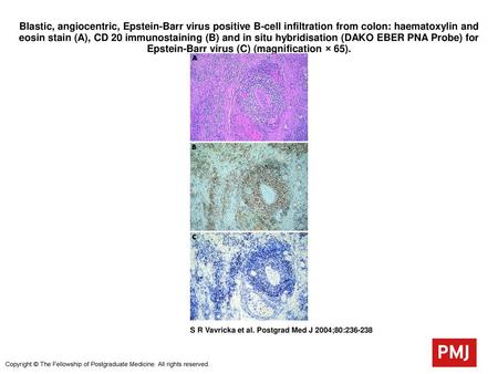 Blastic, angiocentric, Epstein-Barr virus positive B-cell infiltration from colon: haematoxylin and eosin stain (A), CD 20 immunostaining (B) and in situ.