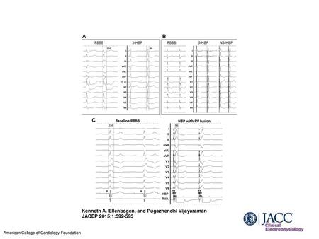 Correction of RBBB by His Bundle Pacing (A) Surface 12-lead electrocardiogram (ECG) of a patient with chronic right bundle branch block (RBBB) and a QRS.