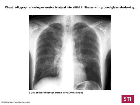 Chest radiograph showing extensive bilateral interstitial infiltrates with ground glass shadowing. Chest radiograph showing extensive bilateral interstitial.