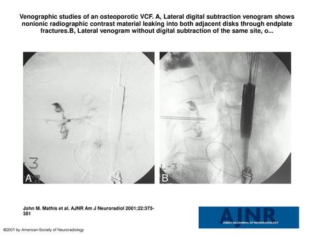 Venographic studies of an osteoporotic VCF