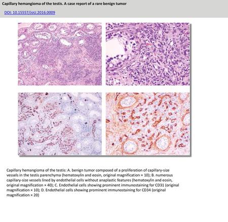 Capillary hemangioma of the testis