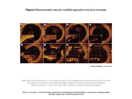 Figure 5 Bioresorbable vascular scaffold apposition and strut coverage