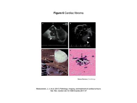 Figure 6 Cardiac fibroma