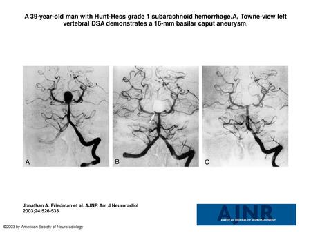 A 39-year-old man with Hunt-Hess grade 1 subarachnoid hemorrhage