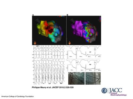 Philippe Maury et al. JACEP 2016;2: