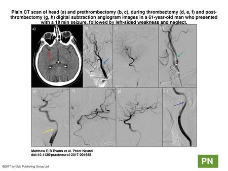 Plain CT scan of head (a) and prethrombectomy (b, c), during thrombectomy (d, e, f) and post-thrombectomy (g, h) digital subtraction angiogram images in.