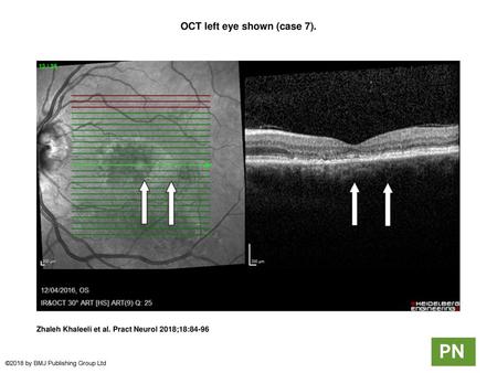 OCT left eye shown (case 7).