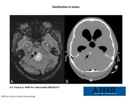 Calcification in tumor.