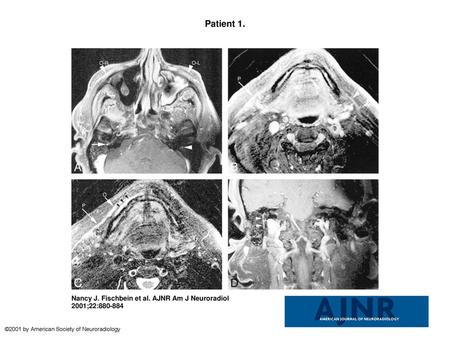 Patient 1. Patient 1. A, An axial T1-weighted postcontrast image with fat saturation (600/13/2 [TR/TE/excitations]) demonstrates asymmetrical enhancement.