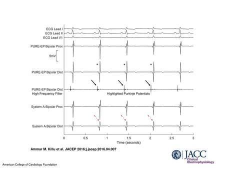 Ammar M. Killu et al. JACEP 2016;j.jacep