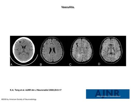 Vasculitis. Vasculitis. This 16-year-old girl with systemic lupus erythematosus, chronic pancreatitis, nephritis, hypertension, cerebritis, and epilepsy.