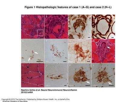 Figure 1 Histopathologic features of case 1 (A–G) and case 2 (H–L)‏