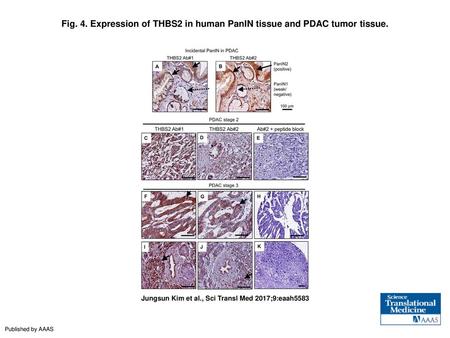 Expression of THBS2 in human PanIN tissue and PDAC tumor tissue