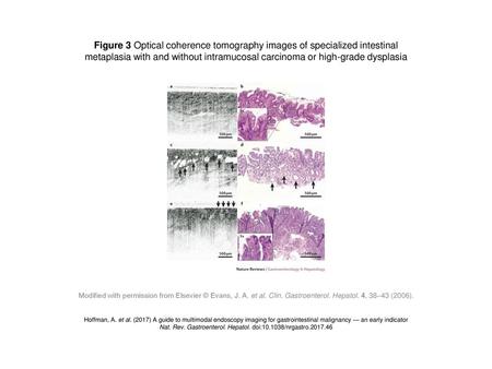 Figure 3 Optical coherence tomography images of specialized intestinal