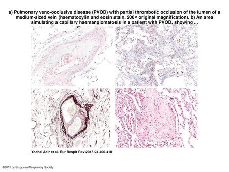 A) Pulmonary veno-occlusive disease (PVOD) with partial thrombotic occlusion of the lumen of a medium-sized vein (haematoxylin and eosin stain, 200× original.