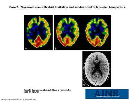 Case 2: 69-year-old man with atrial fibrillation and sudden onset of left-sided hemiparesis. Case 2: 69-year-old man with atrial fibrillation and sudden.