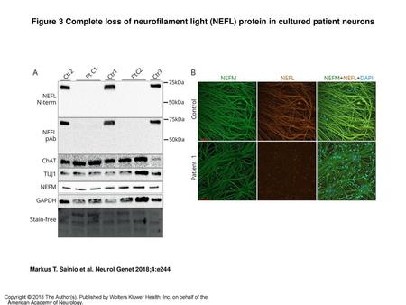 Figure 3 Complete loss of neurofilament light (NEFL) protein in cultured patient neurons Complete loss of neurofilament light (NEFL) protein in cultured.