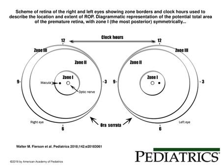 Scheme of retina of the right and left eyes showing zone borders and clock hours used to describe the location and extent of ROP. Diagrammatic representation.