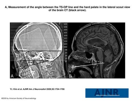 A, Measurement of the angle between the TS-OP line and the hard palate in the lateral scout view of the brain CT (black arrow). A, Measurement of the angle.