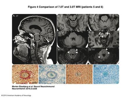 Figure 4 Comparison of 7.0T and 3.0T MRI (patients 5 and 6)‏