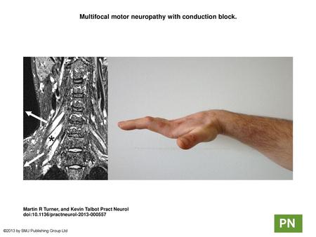 Multifocal motor neuropathy with conduction block.