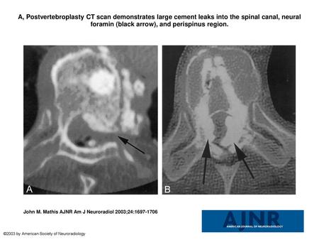 A, Postvertebroplasty CT scan demonstrates large cement leaks into the spinal canal, neural foramin (black arrow), and perispinus region. A, Postvertebroplasty.