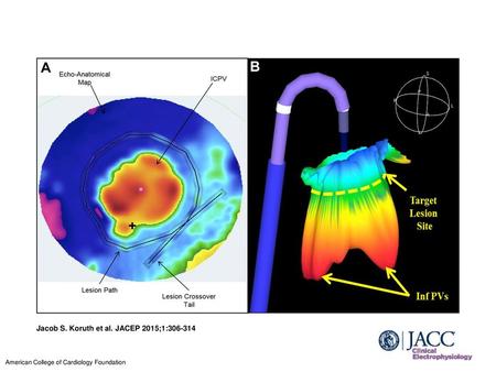 Jacob S. Koruth et al. JACEP 2015;1: