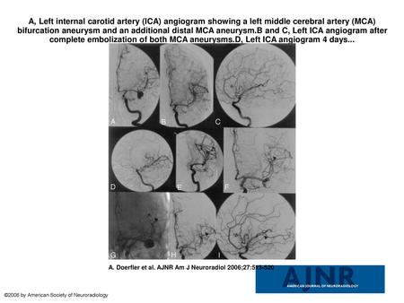 A, Left internal carotid artery (ICA) angiogram showing a left middle cerebral artery (MCA) bifurcation aneurysm and an additional distal MCA aneurysm.B.