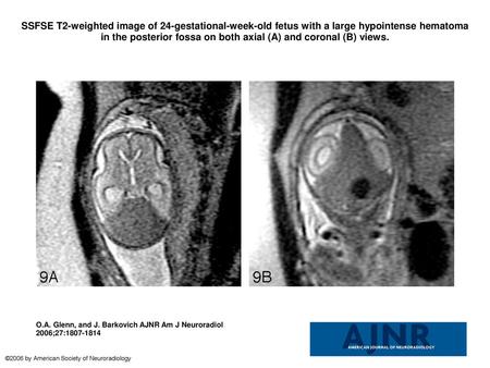 SSFSE T2-weighted image of 24-gestational-week-old fetus with a large hypointense hematoma in the posterior fossa on both axial (A) and coronal (B) views.