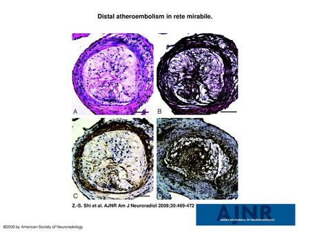 Distal atheroembolism in rete mirabile.