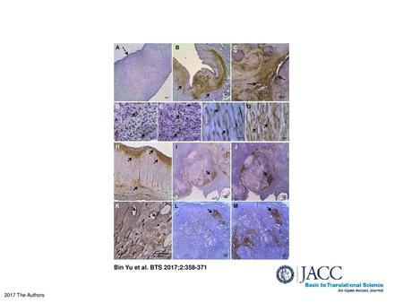 Immunostaining of LPA and OxPLs in Human Aortic Valve Tissues (A) Normal valve shows no obvious LPA immunoreactivity; aorta side on top (dashed arrow).