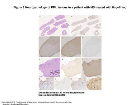 Figure 2 Neuropathology of PML lesions in a patient with MS treated with fingolimod Neuropathology of PML lesions in a patient with MS treated with fingolimod.