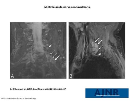 Multiple acute nerve root avulsions.