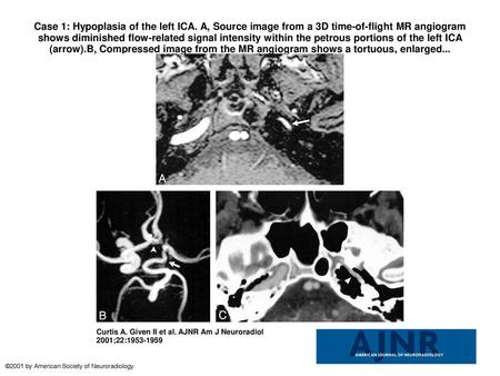 Case 1: Hypoplasia of the left ICA