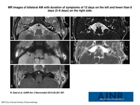 MR images of bilateral AM with duration of symptoms of 12 days on the left and fewer than 6 days (3–6 days) on the right side. MR images of bilateral AM.