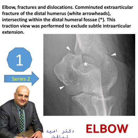 Elbow, fractures and dislocations