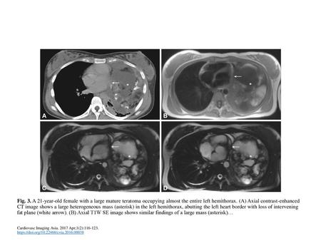 Fig. 3. A 21-year-old female with a large mature teratoma occupying almost the entire left hemithorax. (A) Axial contrast-enhanced CT image shows a large.