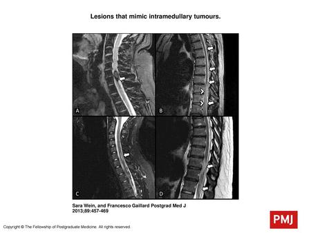 Lesions that mimic intramedullary tumours.